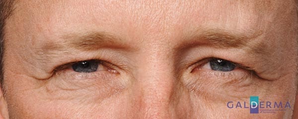 Close up of man's face after receiving anti-wrinkle treatment at a cosmetic clinic - wrinkles around his eyes have been reduced and are smooth