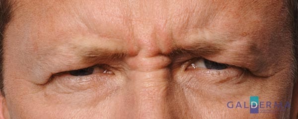 Close up of man's face before receiving anti-wrinkle treatment at a cosmetic clinic