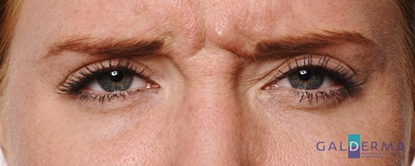 Close-up of female's face before receiving anti-wrinkle treatment showing crows feet and lines around eyes.